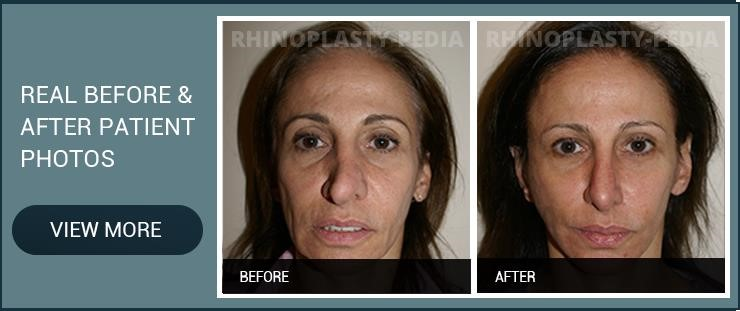 rhinoplasty surgeons