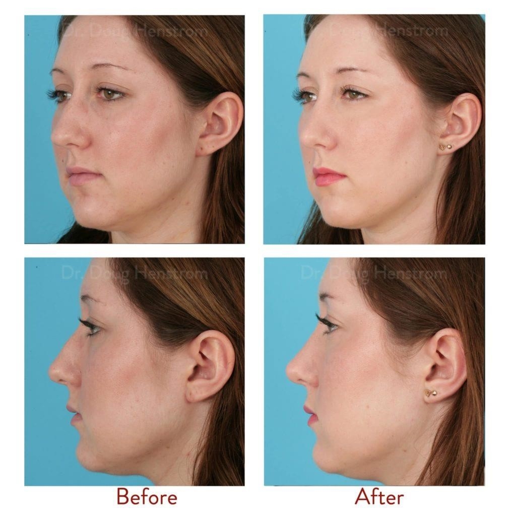 rhinoplasty surgeons