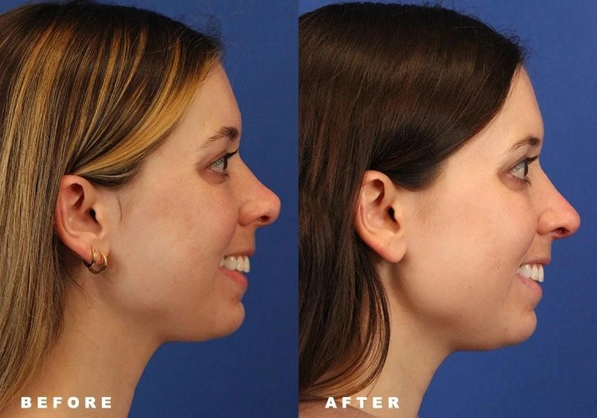 rhinoplasty surgeons